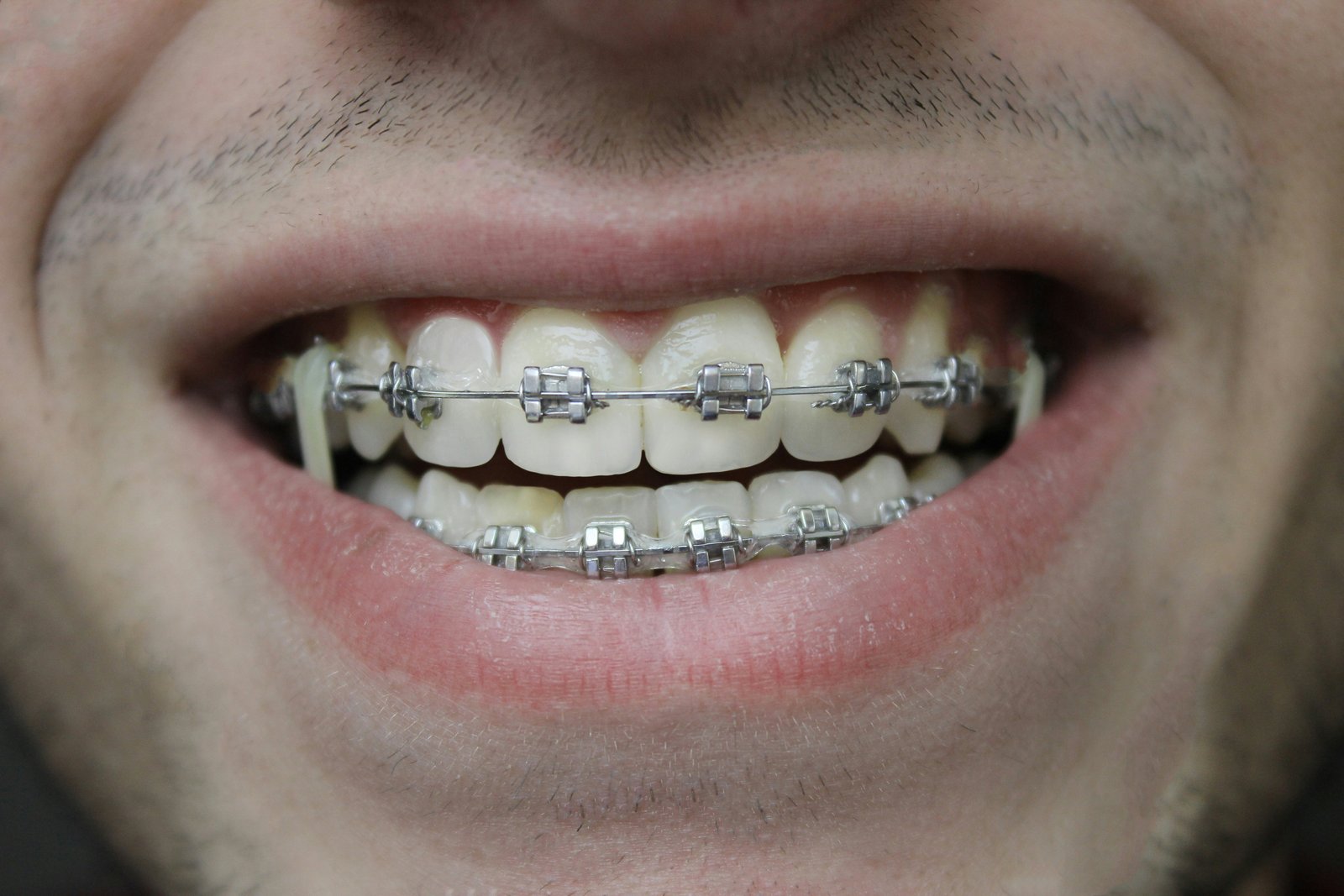 Orthodontic Treatment