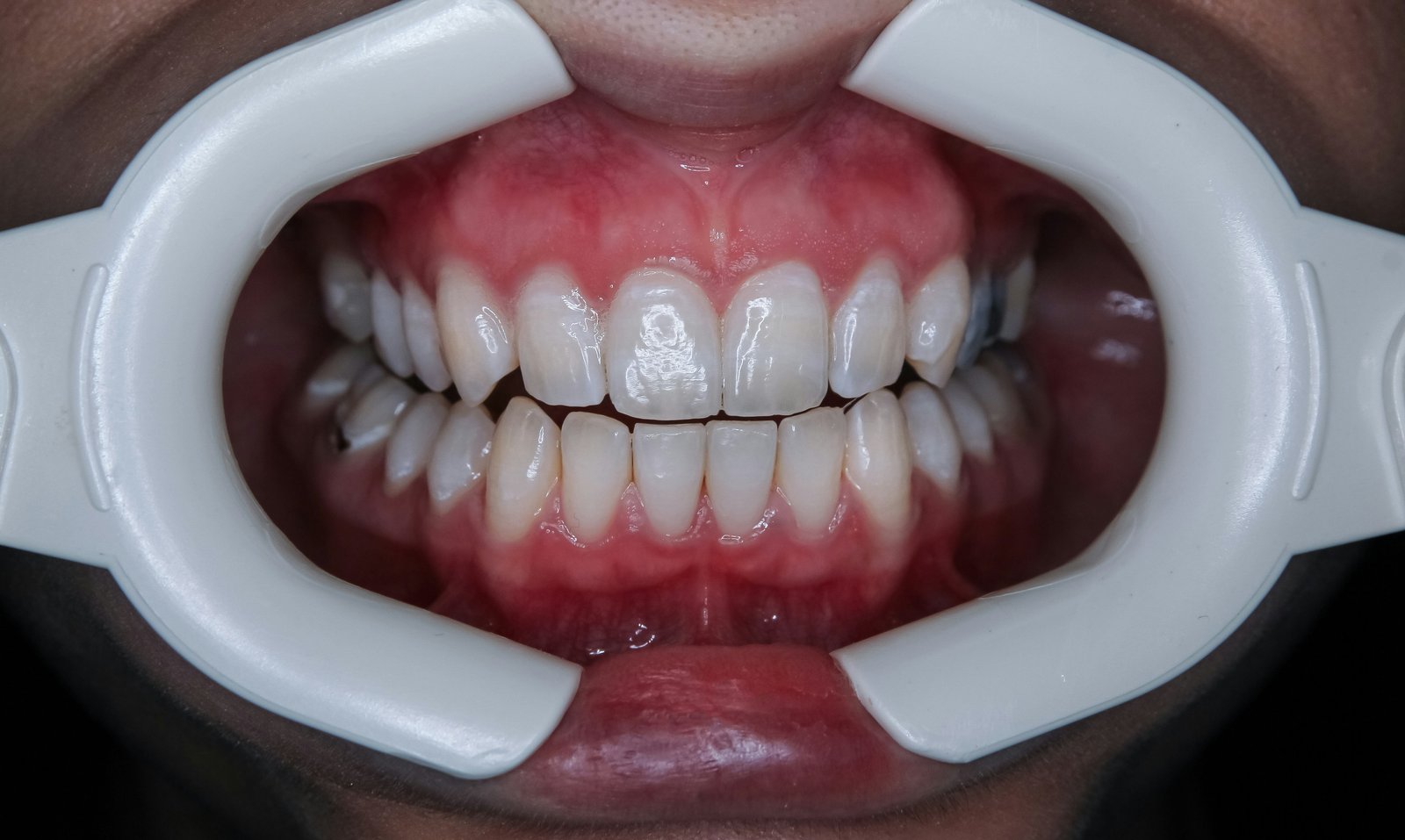 Full Denture